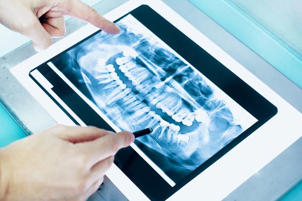 Dental x-ray of a full mouth Dental x-ray of a full mouth